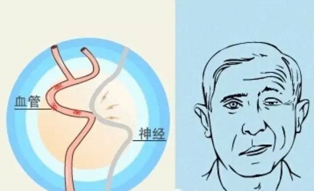 面肌痉挛