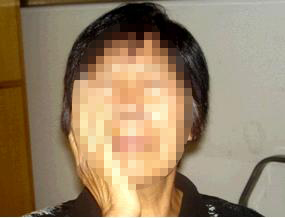 张女士　三叉神经痛二支